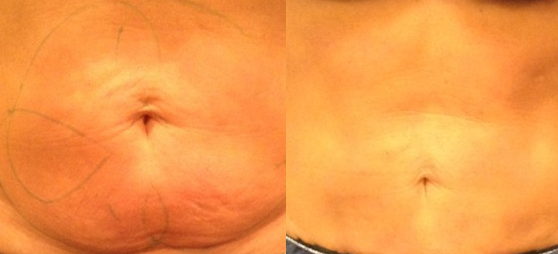Coolsculpting after 1 treatment 60 days 4 cycles