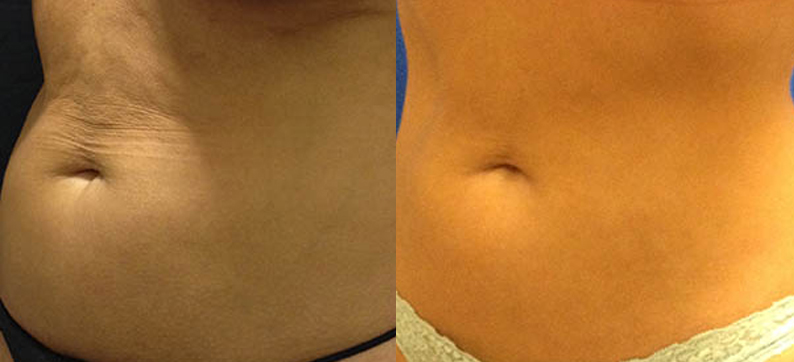 1 round of Coolsculpting