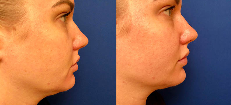 Chin and Marionette Line correction with Juvederm Ultra Plus
