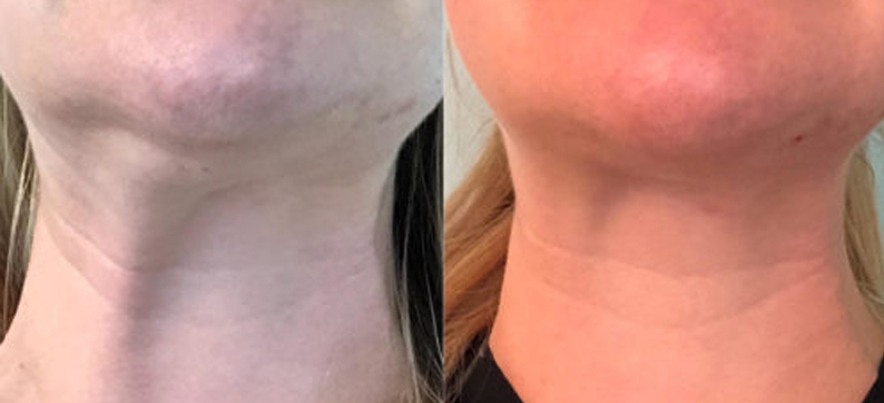Kybella Neck Treatment Before and After