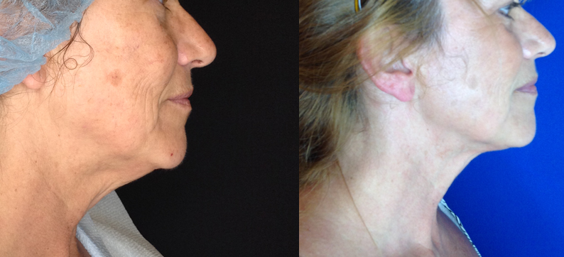 Facetite 6 month follow up Jowl Neck and under the chin