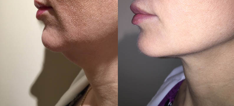 Kybella for under the chin