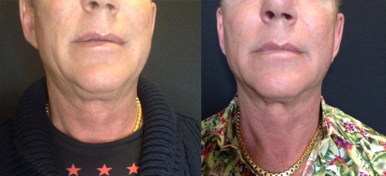 AccuTite, Jowl, Marionette and Upper Lids, 3 Months After