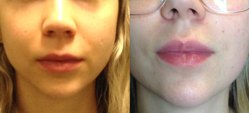 2 Syringes of Juvederm in Lips