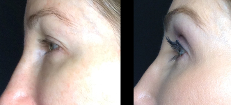 Fibroblast Before After