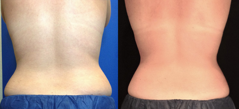 Coolsculpting Before After Flanks