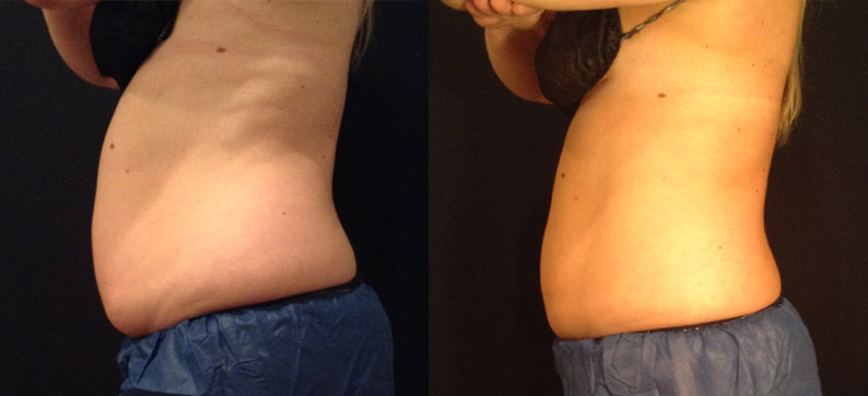 Coolsculpting Before After Abs and Flanks