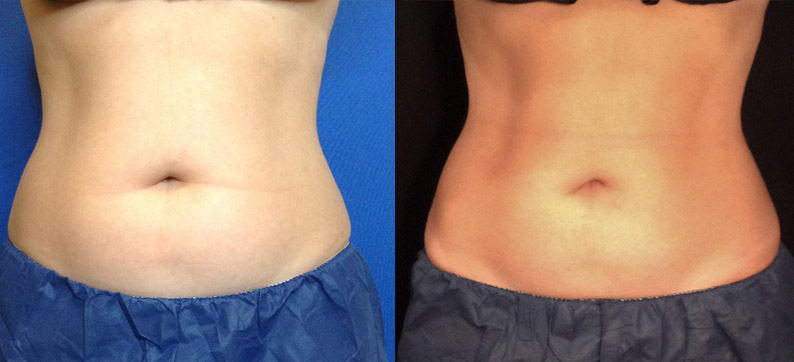 Coolsculpting Before After Abdomen