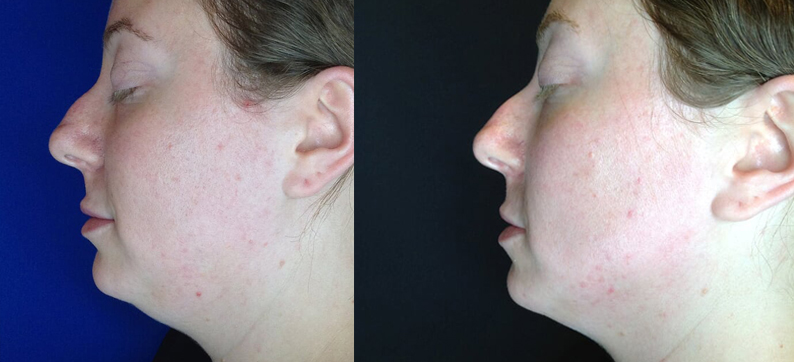 Kybella Before After