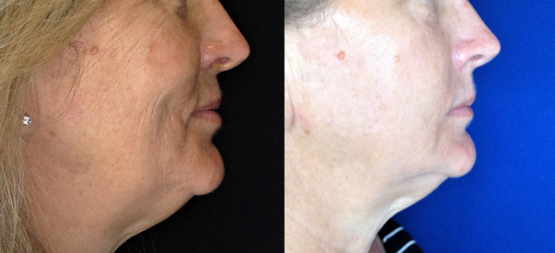 After 2 Morpheus8 treatments to Face and Neck with PRP