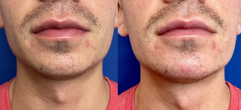 Chin Filler Before After