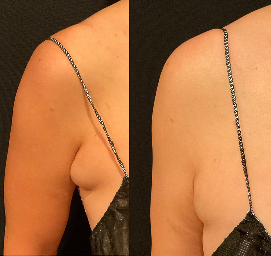 CS Front Bra Fat Area Before After