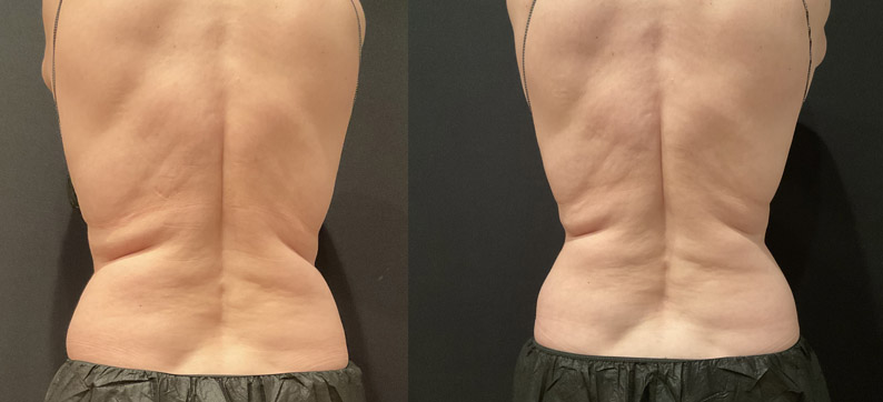 CoolSculpting Flanks After 1 session