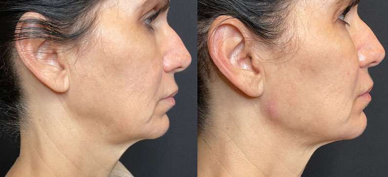 Accutite and jaw filler with Radiesse