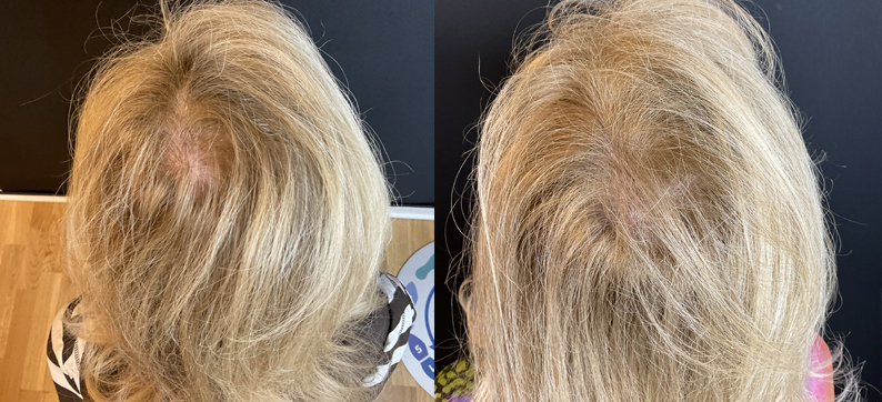 Before After PRP Hair Loss