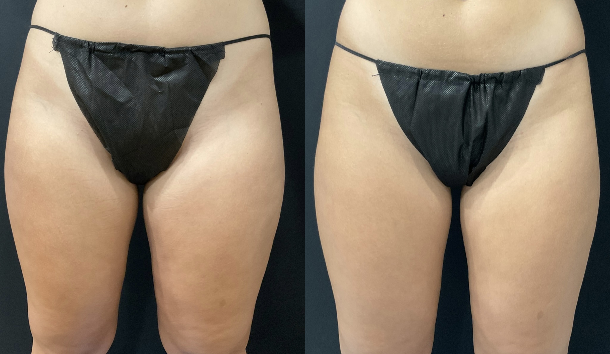 B&A one session CS inner thighs