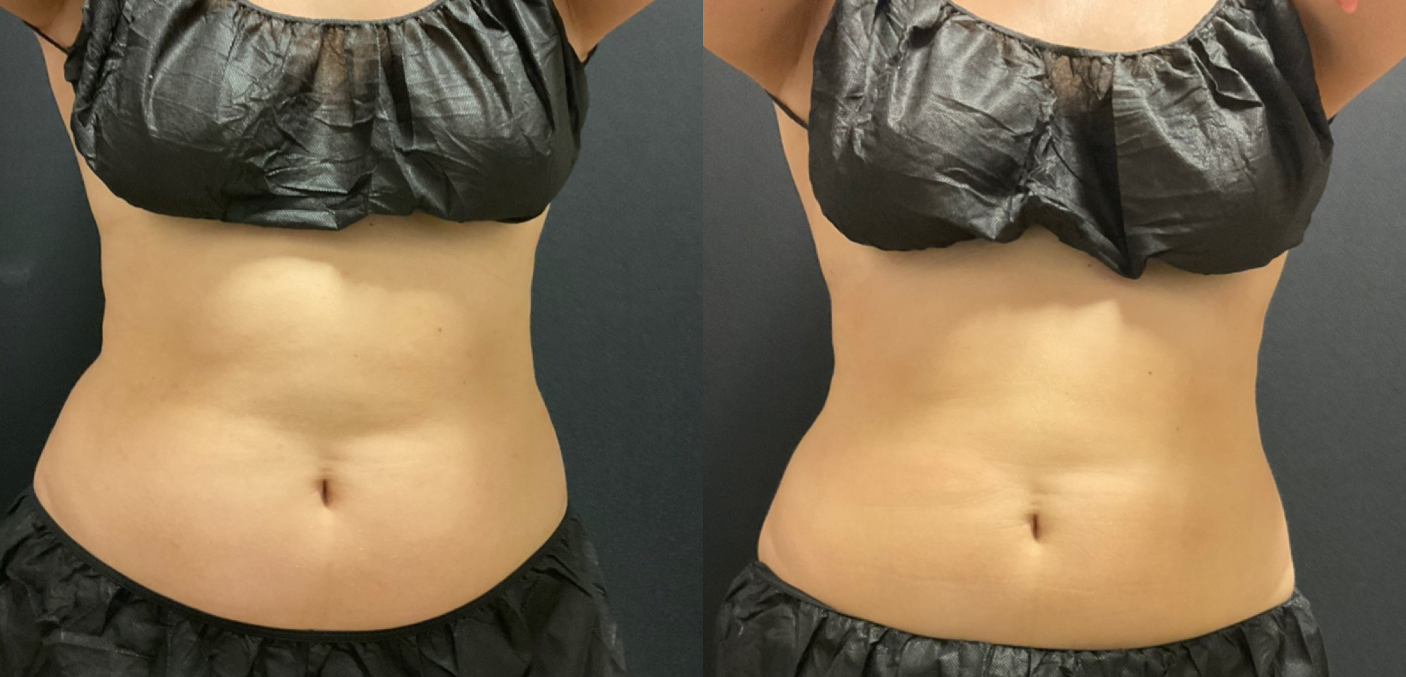 Before & After 1 CS session Abdomen