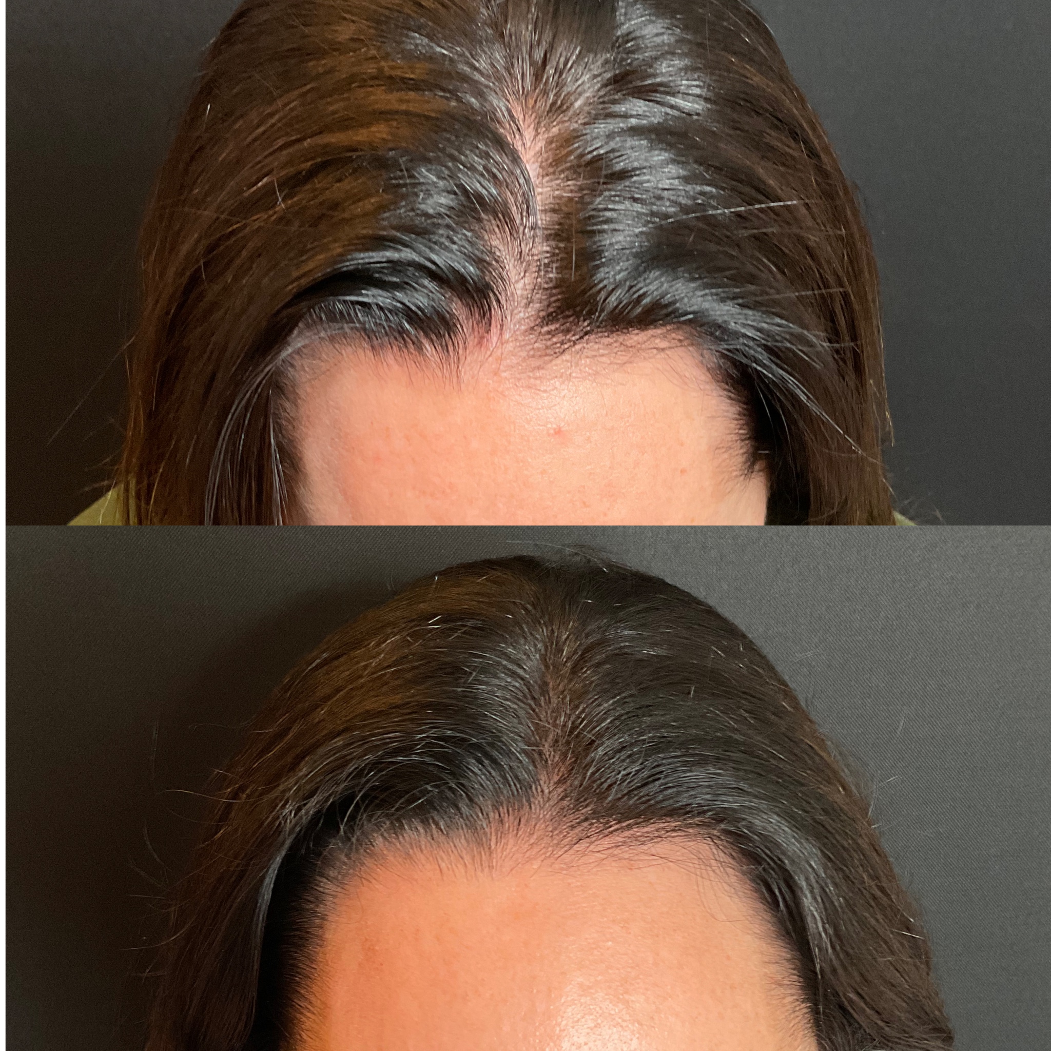 Before and After PRP hair 2 treatments