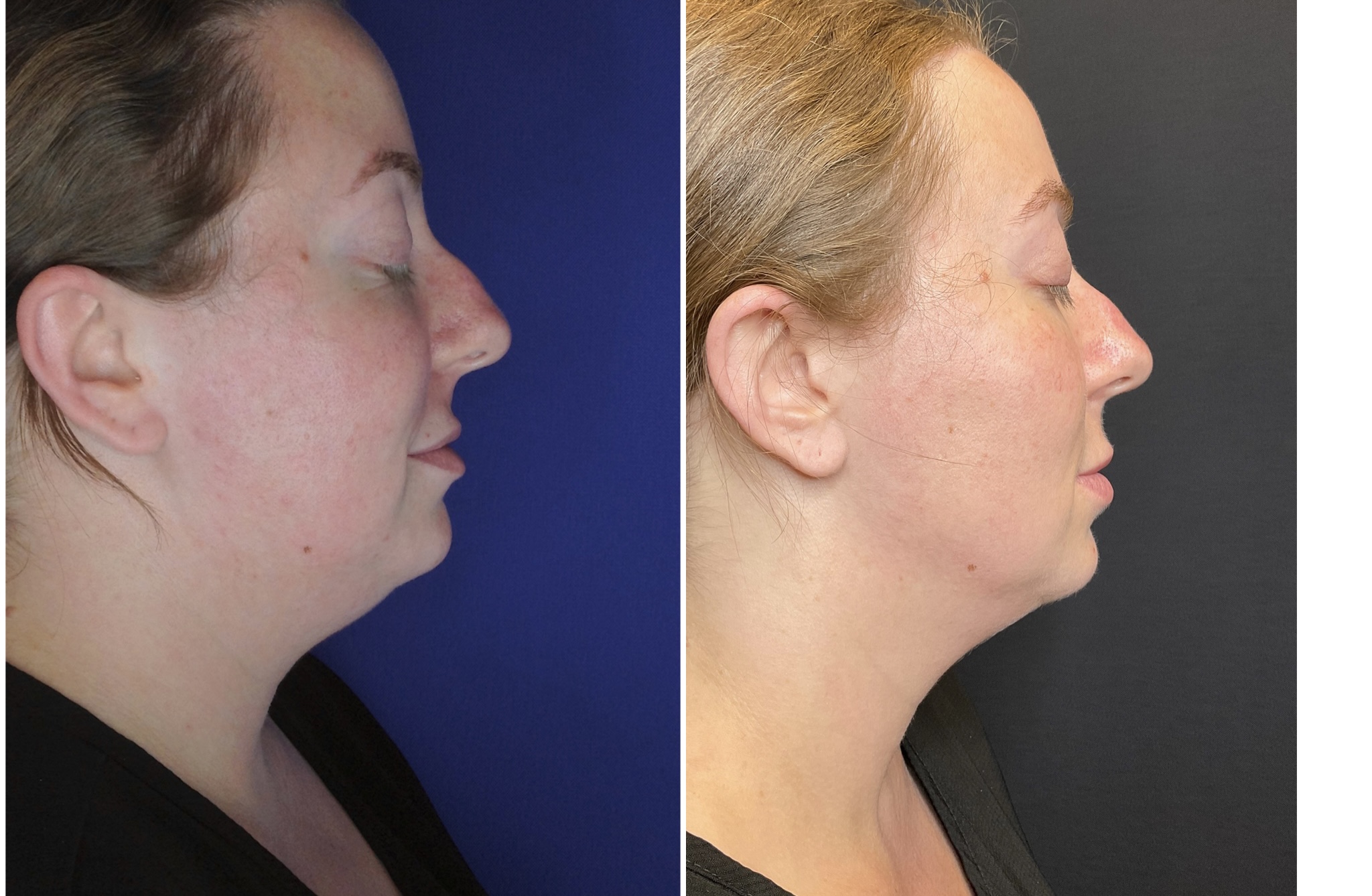 Kybella Injections B&A 3 sessions- Submental