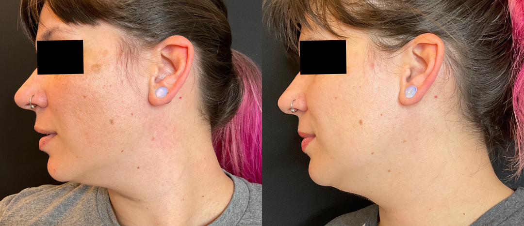 Skincare B&A 2 month regimen