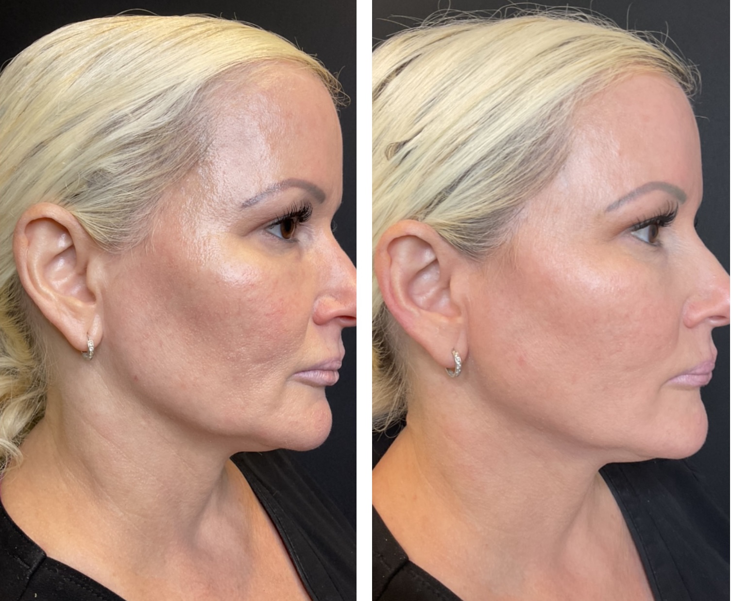 B&A Radiesse Filler for Jawline and Reverse PDO Threads