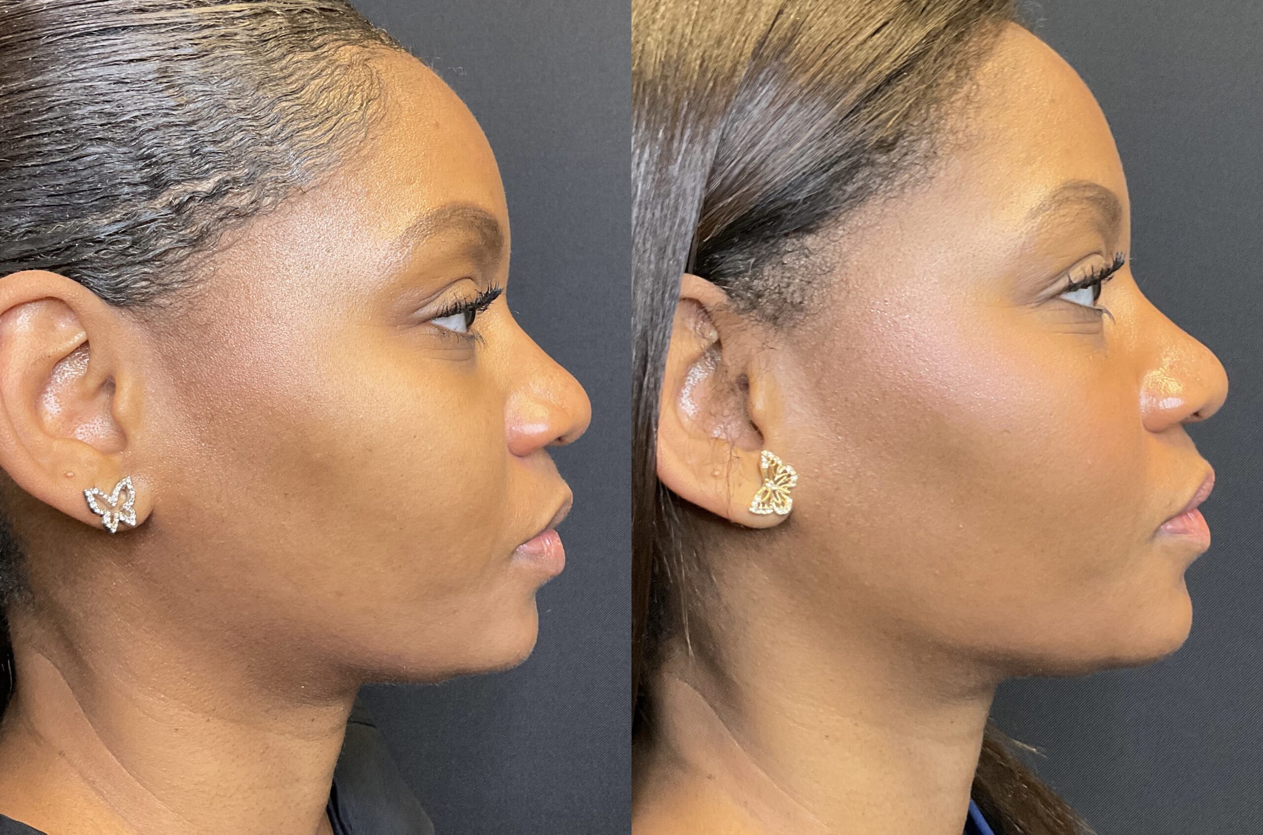 B&A Vollux Filler for Jawline and Voluma Filler for Chin