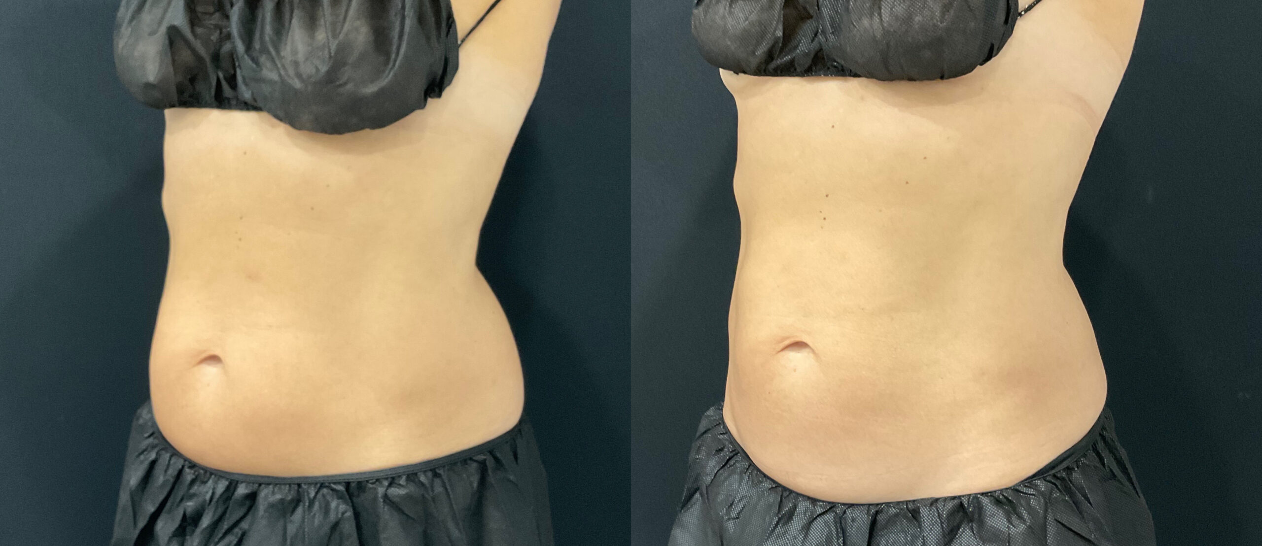 Before and After 1 CS session Lower Abdomen