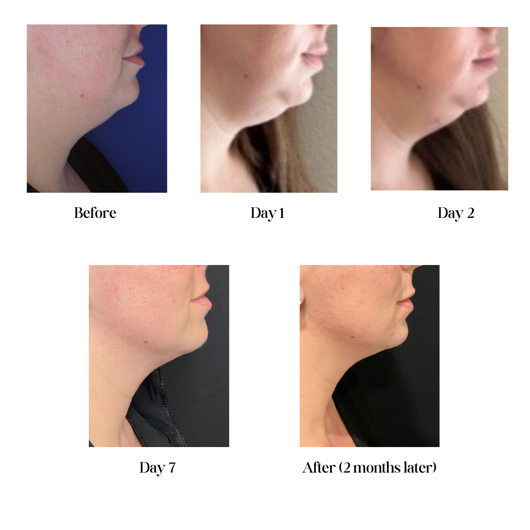 Kybella Before After