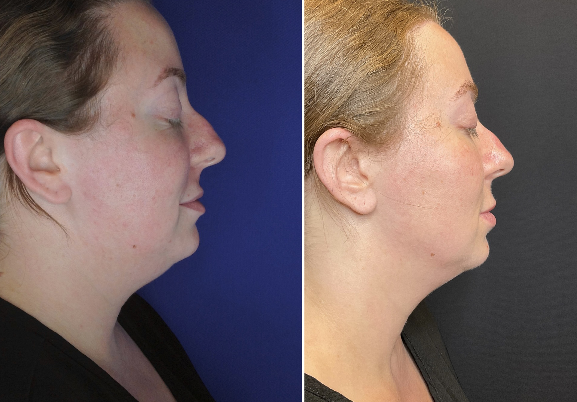 Kybella Injections-B&A 3 sessions- Submental