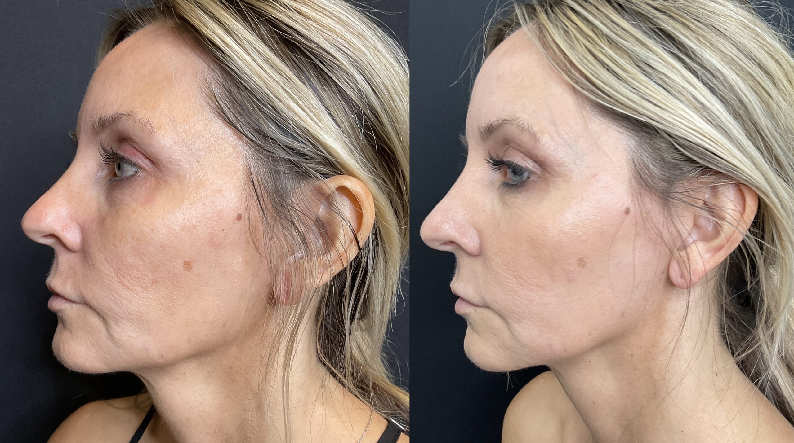 CoolPeel- Full face- pigment and texture- 1 treatment