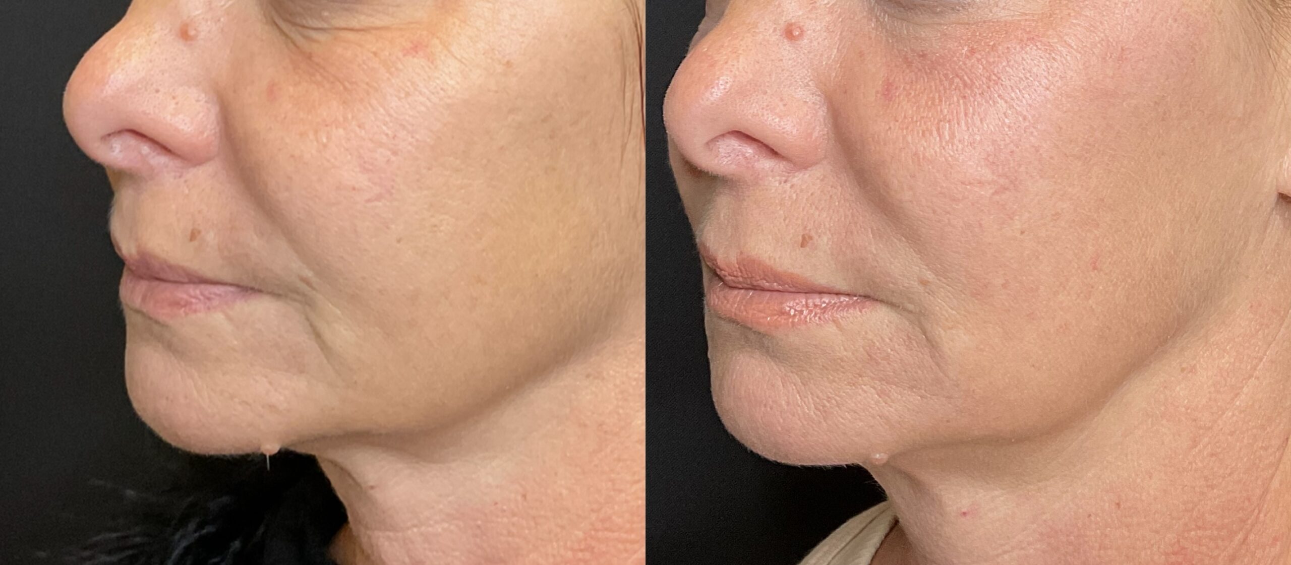 CoolPeel- Lower Face- 1 treatment