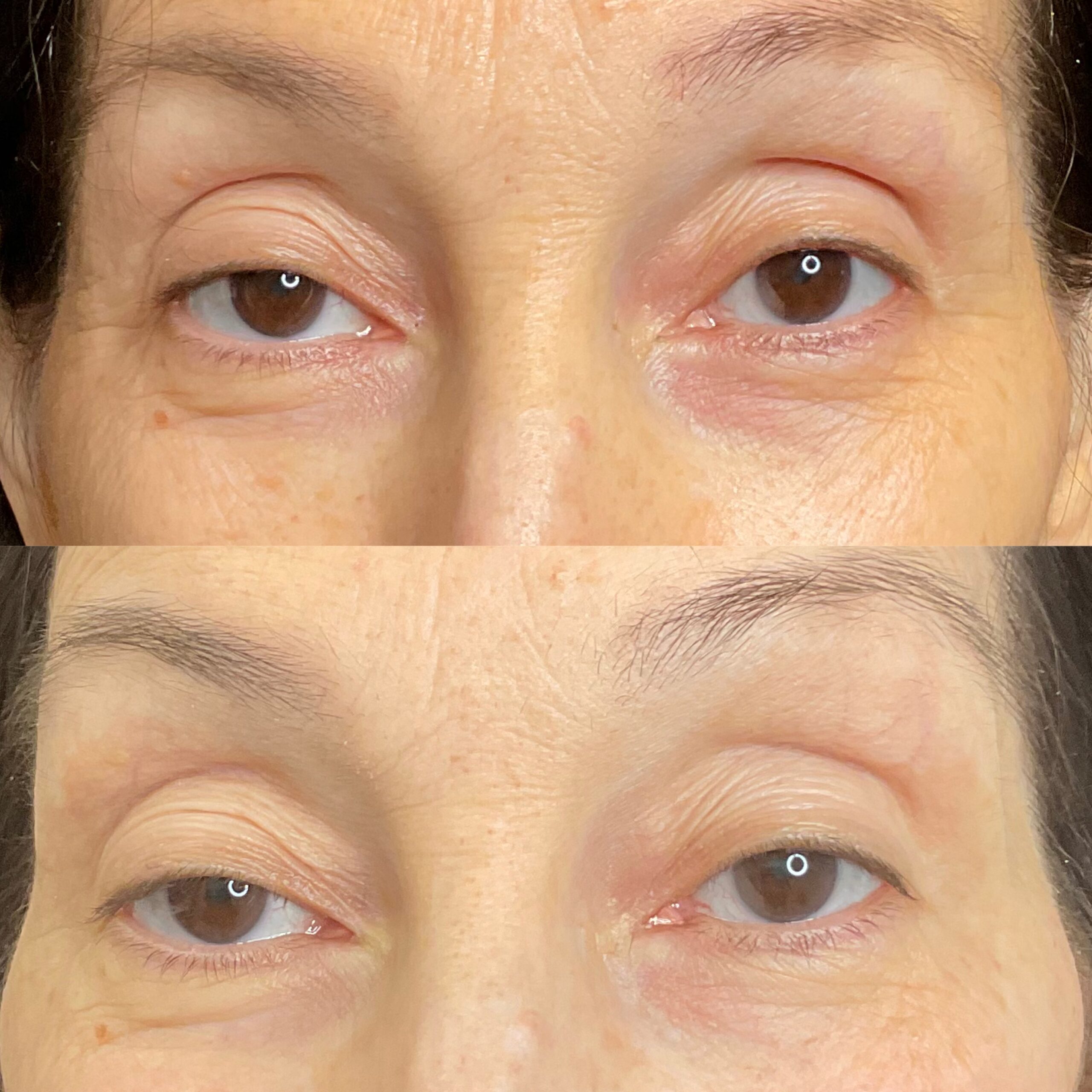Deka-Eyes-1 treatment