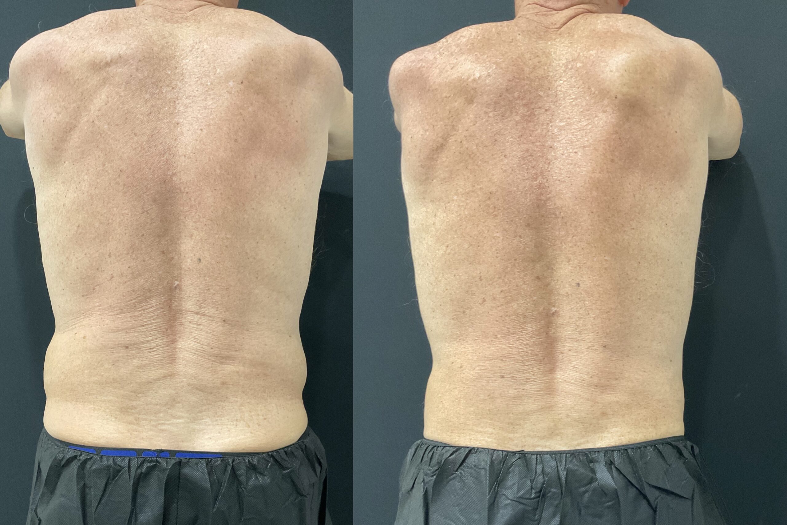 Reduce Back Fat with CoolSculpting