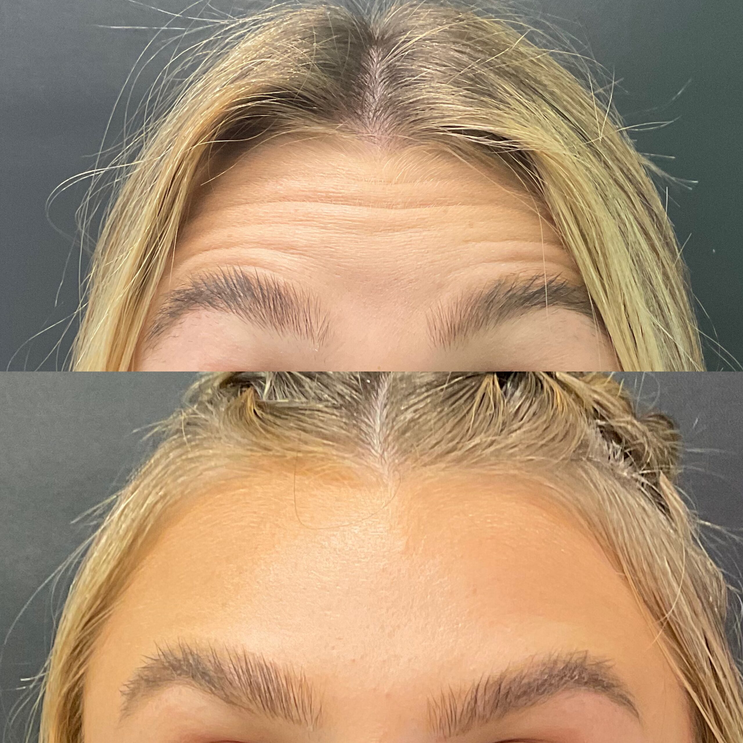 Daxxify FH Before and After (2)