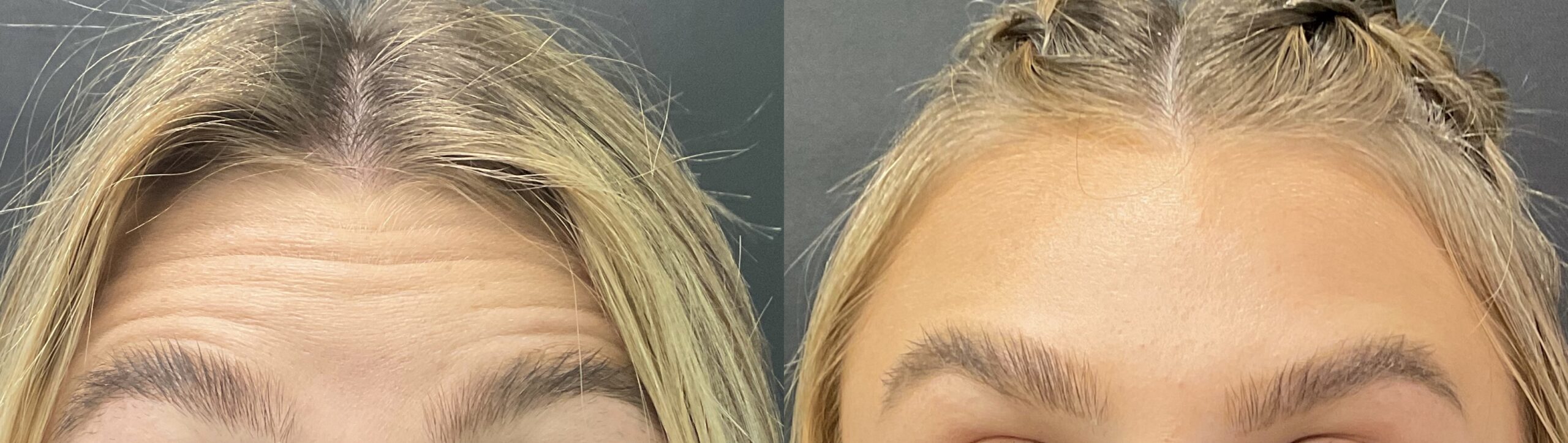 Daxxify FH Before and After