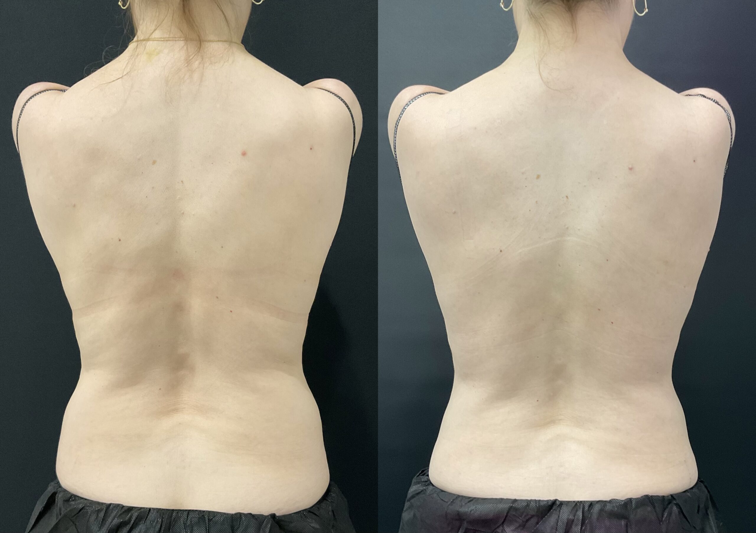 1 Coolsculpting Treatment to Lower Flanks