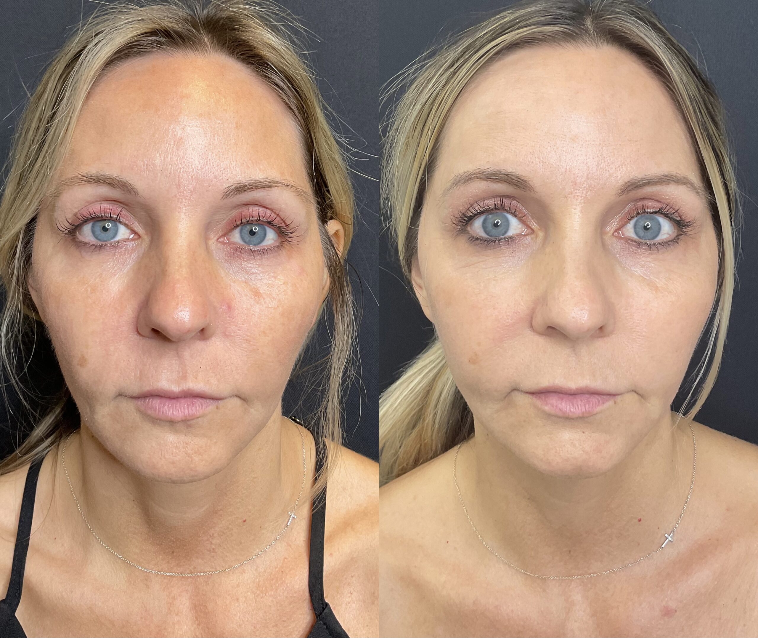 3 CoolPeel treatments face and neck