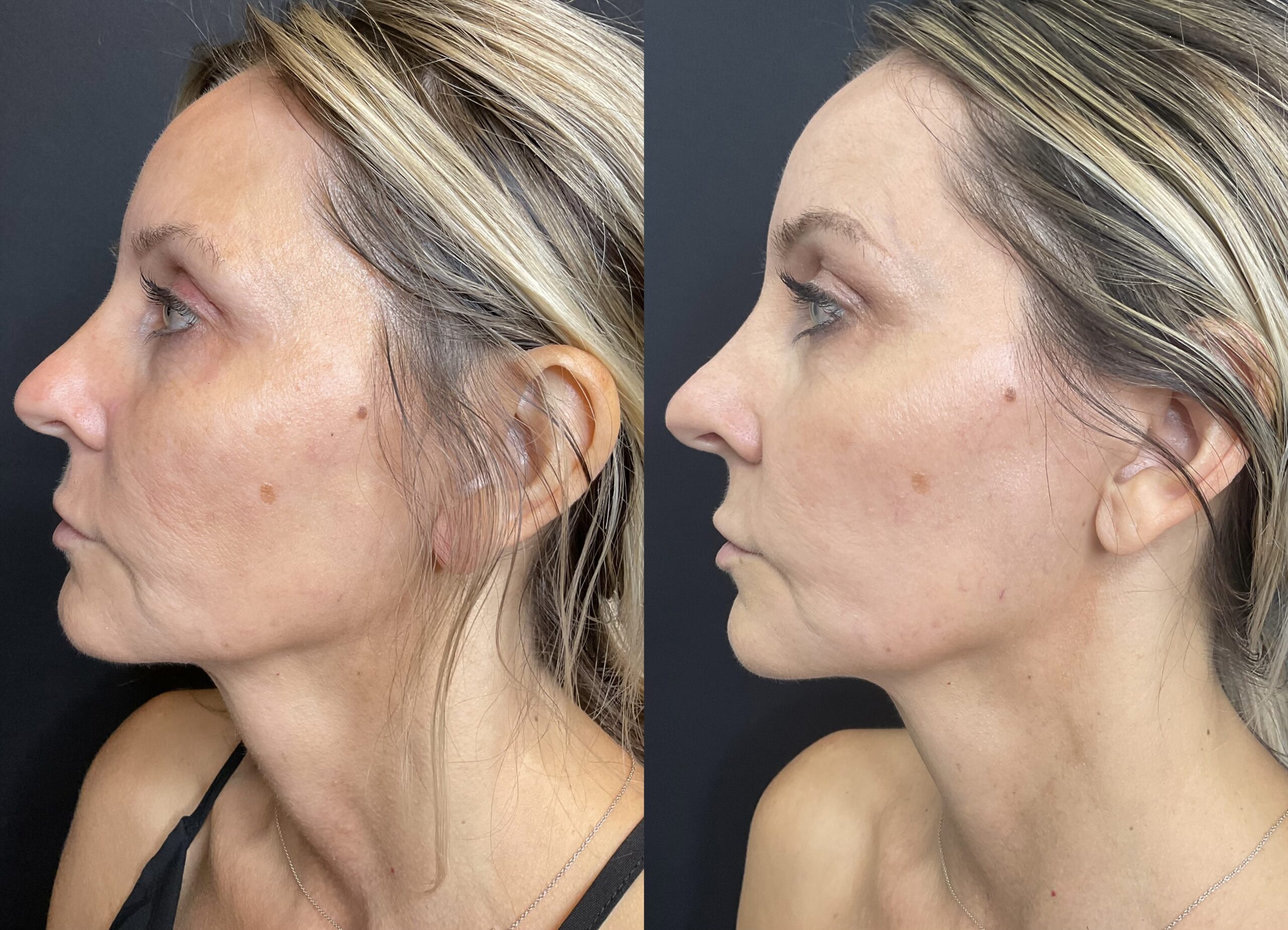 3 CoolPeel tx face and neck