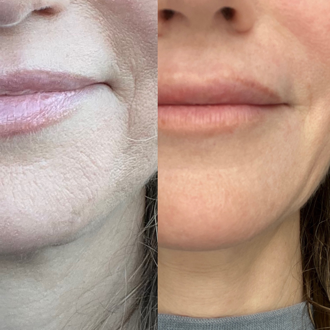 CoolPeel Before After