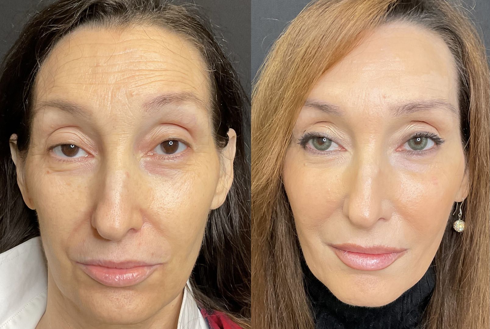 3_Coolpeel_sessions_and_RHA_Fillers_result