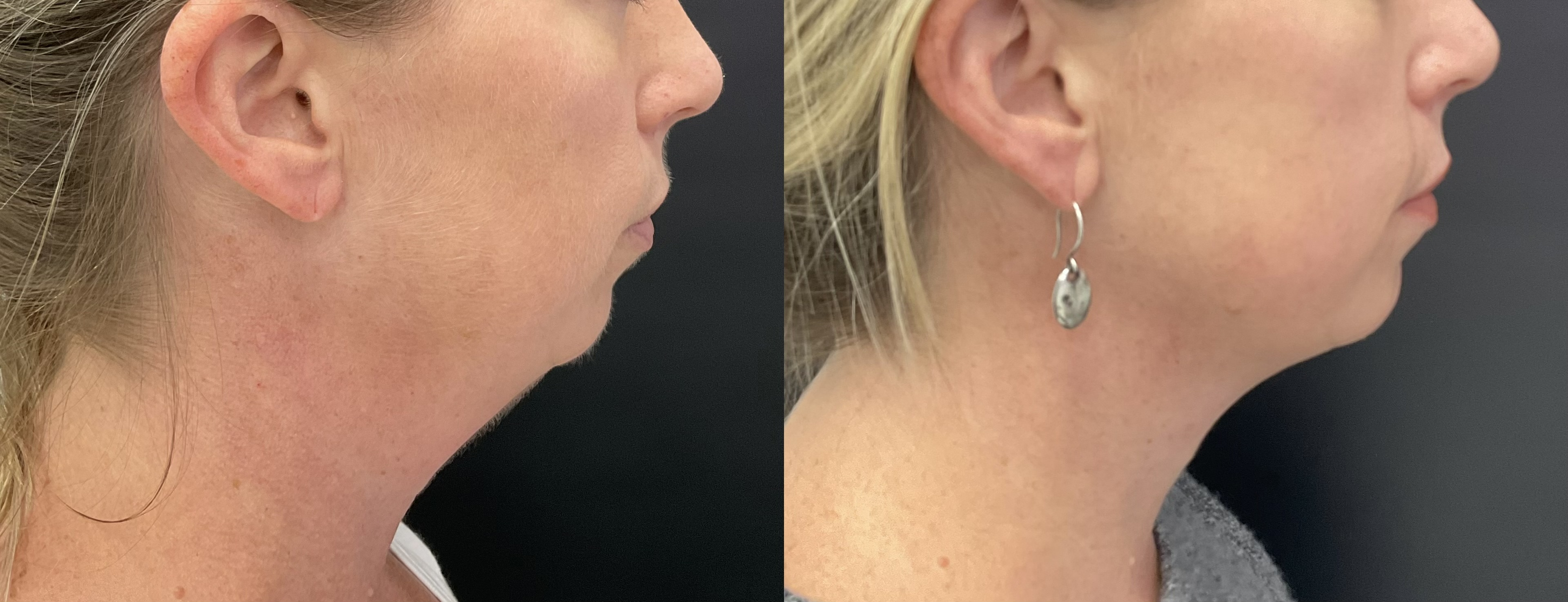 2 sessions of Coolsculpting Chin