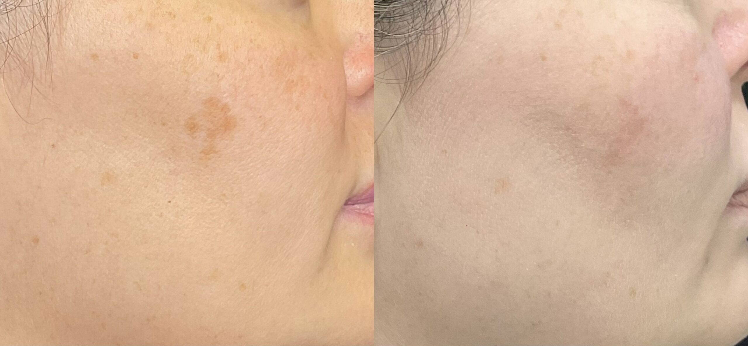 IPL for discoloration