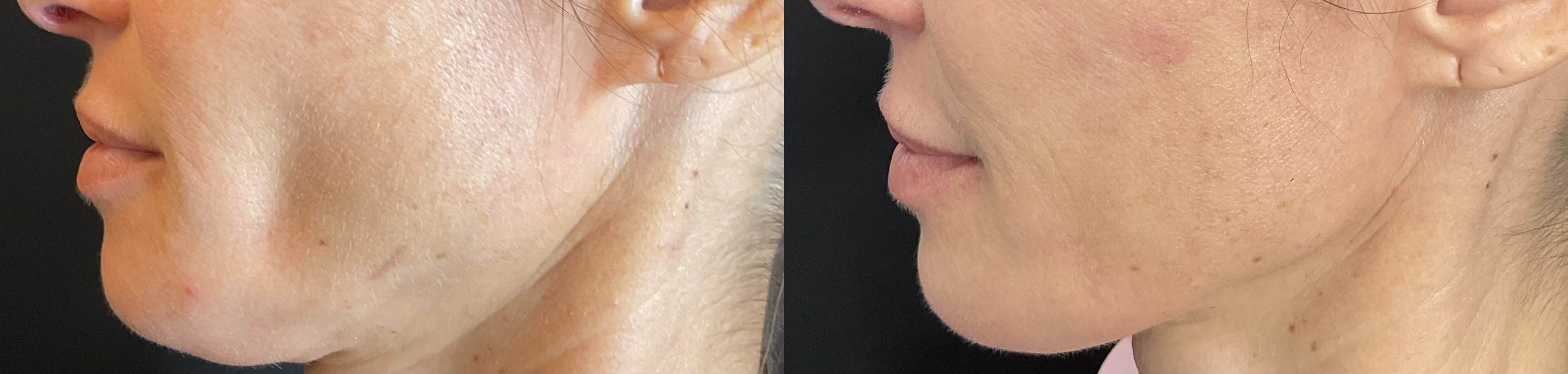 Sculptra correction from dog bite to lower face