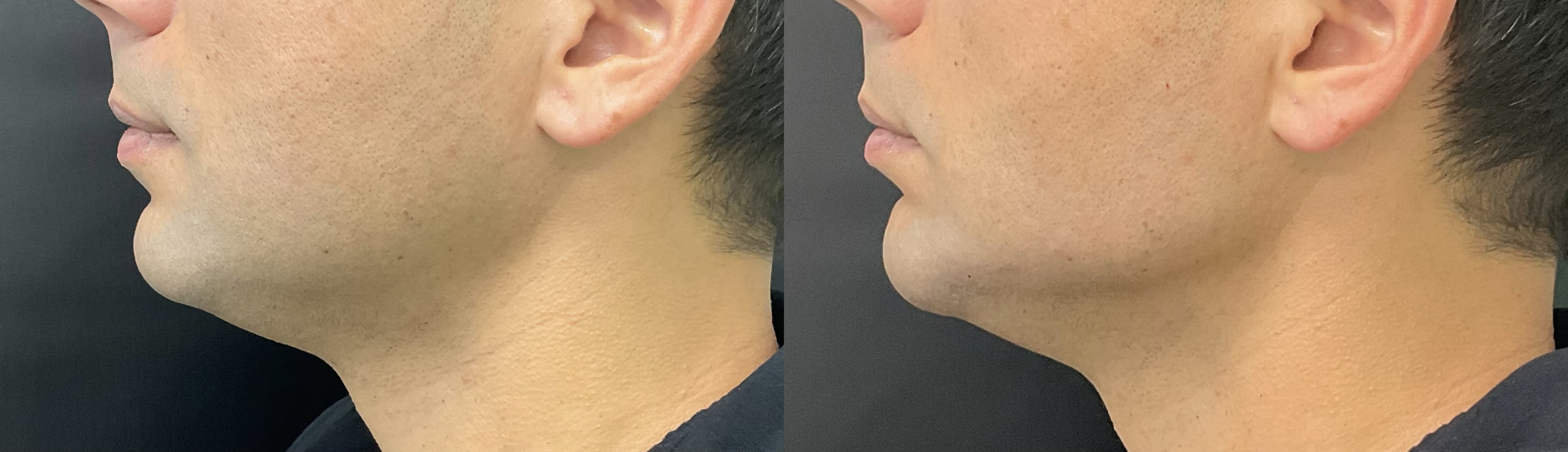 Jawline and Chin Filler- Male