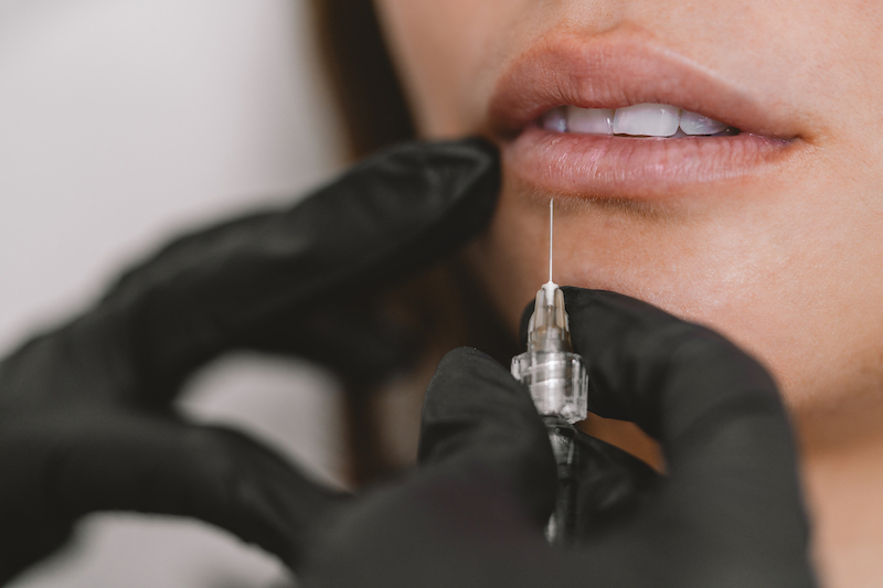 This closeup features an injector injecting lip filler into a woman's lips after she googled "lip filler near me" and discovered Hermann Aesthetics