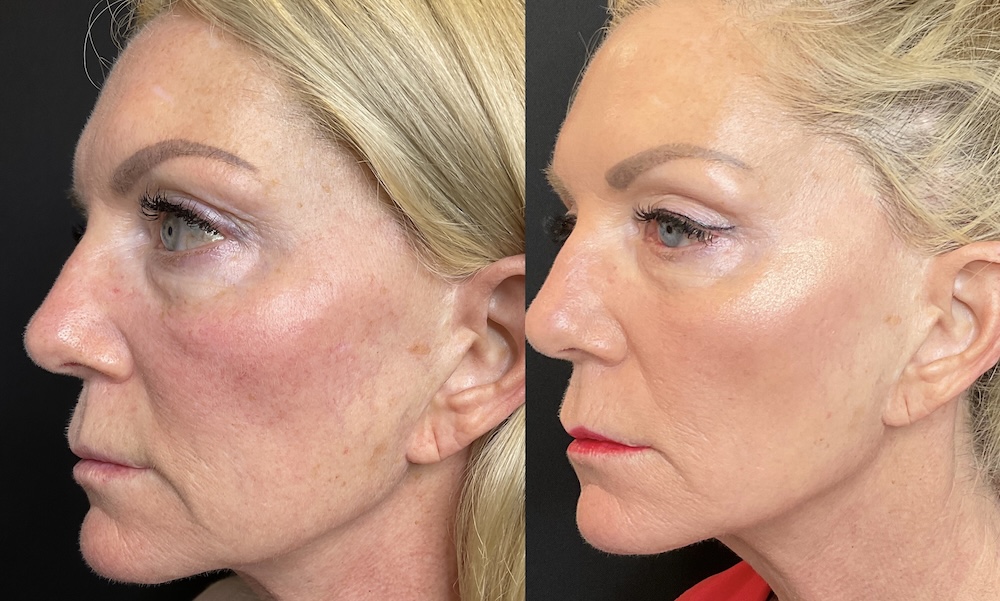 A before and after image of a client's face shows how laser resurfacing in St. Petersburg improved the area around her eyes and evened out skin tone.